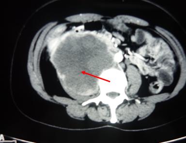 肿瘤二区采用中西医结合治疗（化疗+中药）晚期腹腔肿瘤效果好