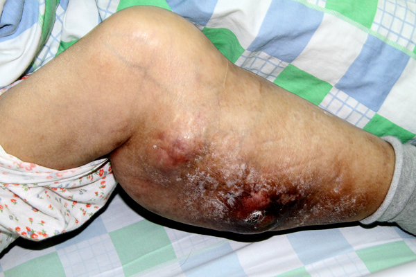 广州七旬老人患骨肉瘤14年面临截肢 射波刀治疗后再次行走