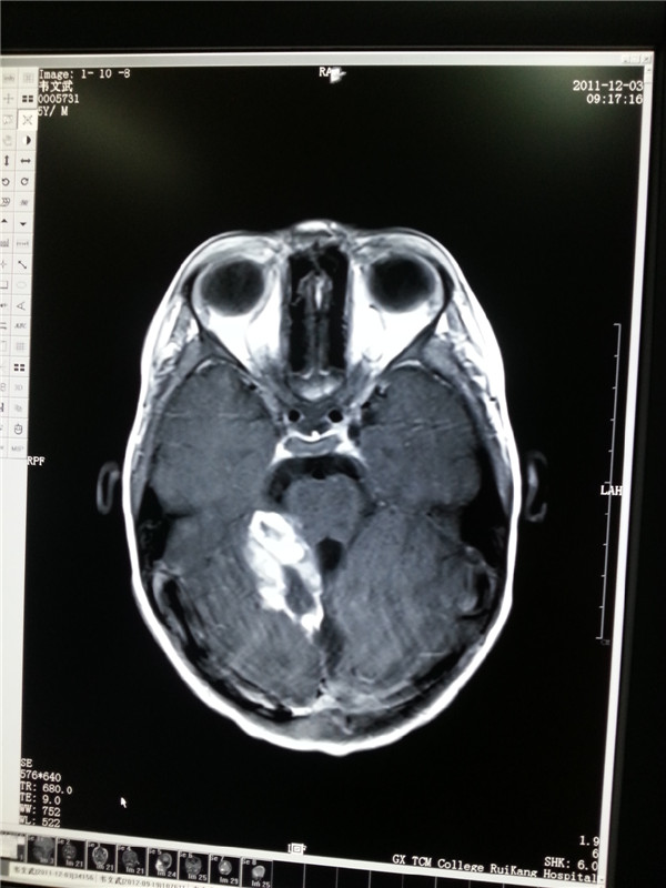 射波刀治疗胶质瘤复发疗效显著