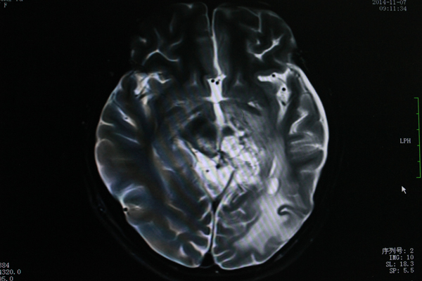 替莫唑胺辅以中药固本花季脑瘤少女重现欢颜