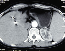 肝癌患者腹痛3年余射波刀治后疼痛随肿瘤一并消失