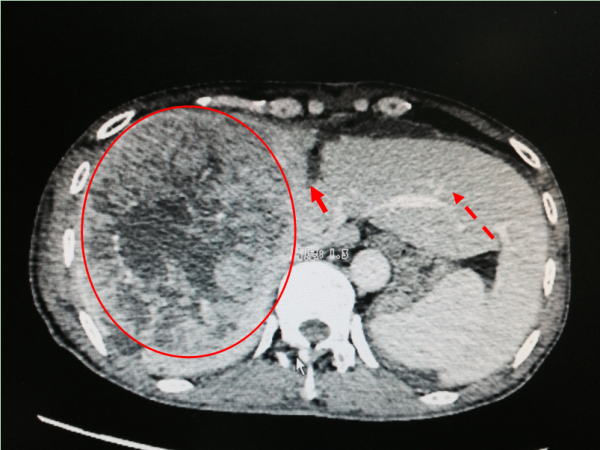 男子二十余年不患病 一病便是巨大肝癌——我院第二例二步肝癌切除术（ALPPS术）成功完成