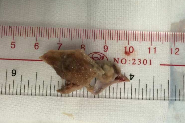 89年无病无灾 却因为一块骨头差点要了他的命