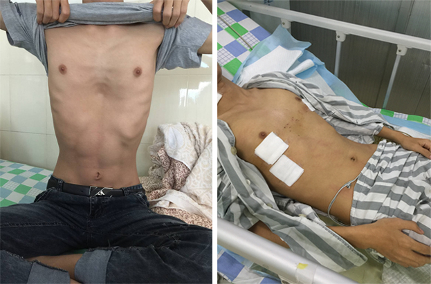 我院漏斗胸矫正术进入微创时代