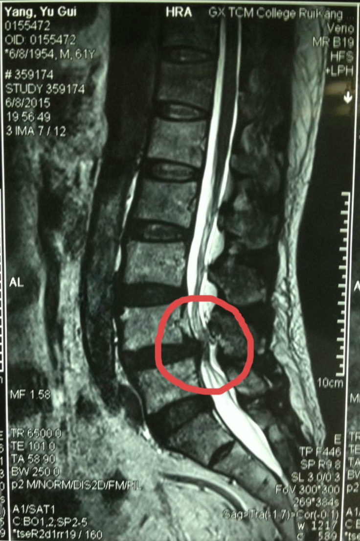三年寻医无果 微创轻松去腰突