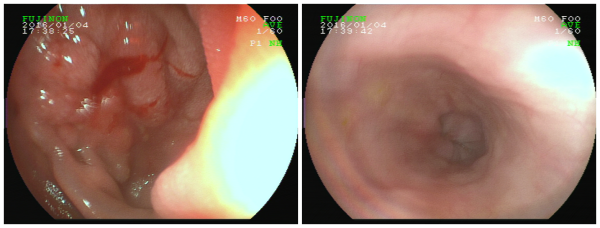 小小牙签竟酿大祸瑞康无痛胃镜异物取出术为男子解忧