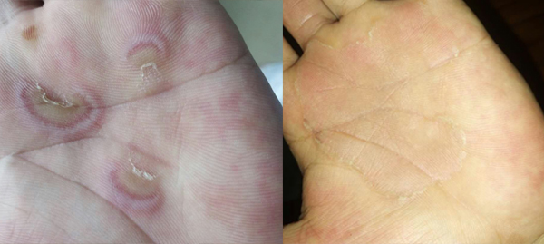 多形红斑久治未愈 中医药辨证药到病除