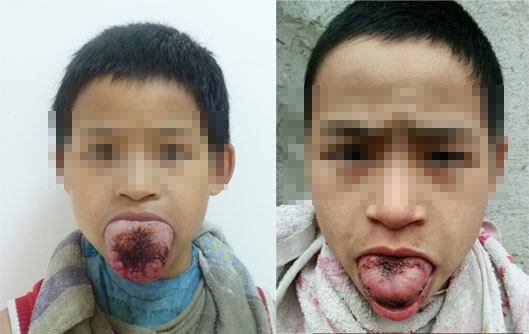 两“巨舌娃”自强不息战病魔 医院援手救治见成效