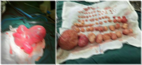 74个肌瘤住在她的子宫 而她竟然以为是怀孕