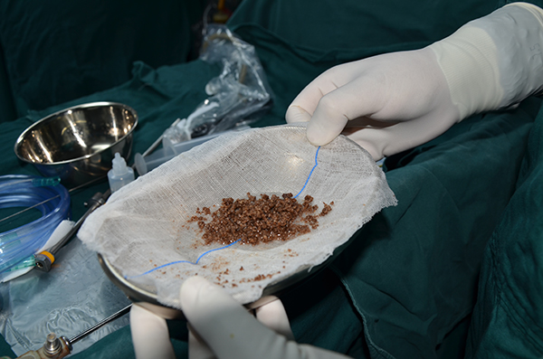 我院田阳院区81岁高龄患者前列腺增生、膀胱结石手术成功