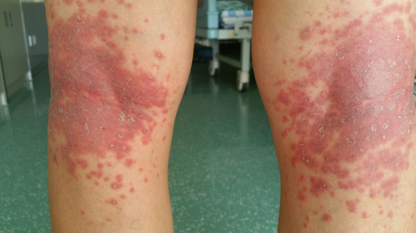 中西医结合治疗特异性皮炎疗效好