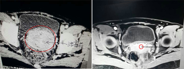 宫颈癌肿拳头大，射波刀治疗90天全消——一宫颈癌患者受病困扰两年最终获治