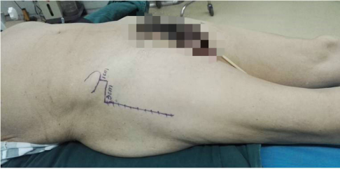 我院髋关节置换技术再获新突破