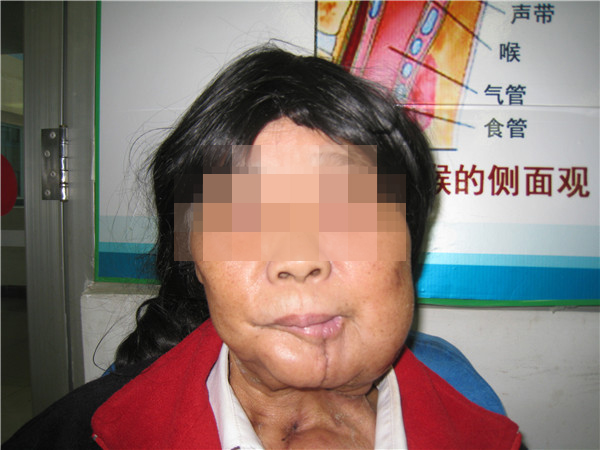 颌面部巨大肿瘤切除，还换了脸！为瑞康医院的专家点赞！