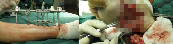 糖尿病足患者的福音：横向骨搬移微循环再生技术