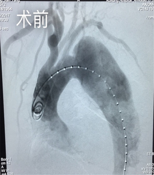 我院成功为主动脉夹层瘤患者实施支架植入术