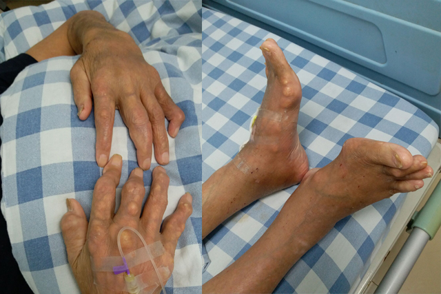 我院成立痛风专科门诊 痛风将得到更加科学和规范治疗