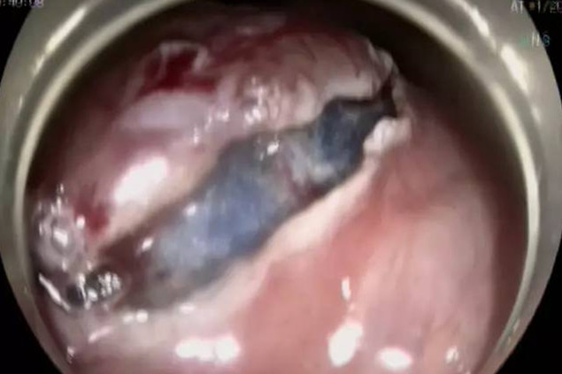 女子患胃间质瘤肚子痛10年 胃镜将瘤一锅端