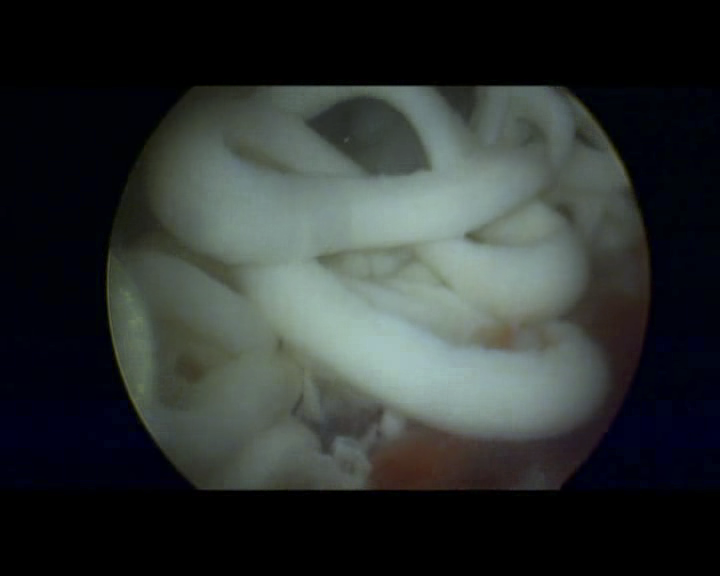 肩膀“挤”出“白色牙膏”原来是肩袖钙化—瑞康医院8月12日举办“肩痛”健康知识讲座