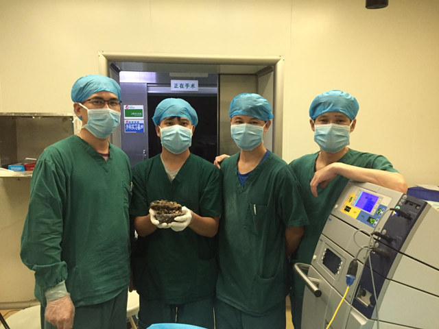 我院为异食癖6岁女童 接力12小时取出肠胃中结石