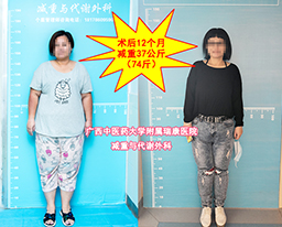 从不认识你到认不出你，减重女孩一年时间实现美丽蜕变——胃肠外科举行减重手术一周年纪念活动