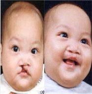 我院耳鼻咽喉头颈外科为唇腭裂患儿提供免费修复手术