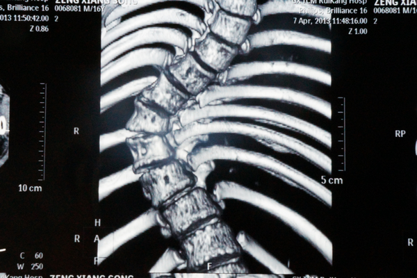 “剃刀背”男孩终于可以昂首挺胸了——我院成功完成一例特发性脊柱侧弯椎体矫形手术