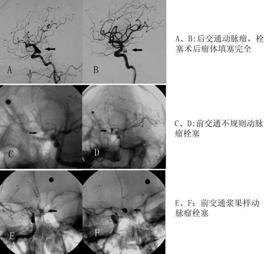 神经介入治疗介绍