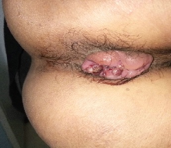 最安全的痔疮微创手术-TST手术