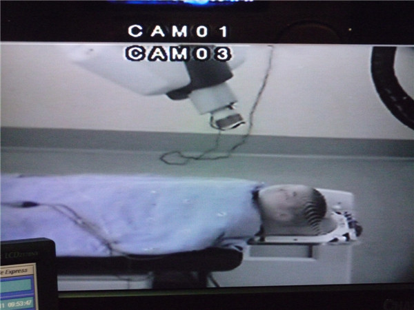 射波刀治疗胶质瘤复发疗效显著