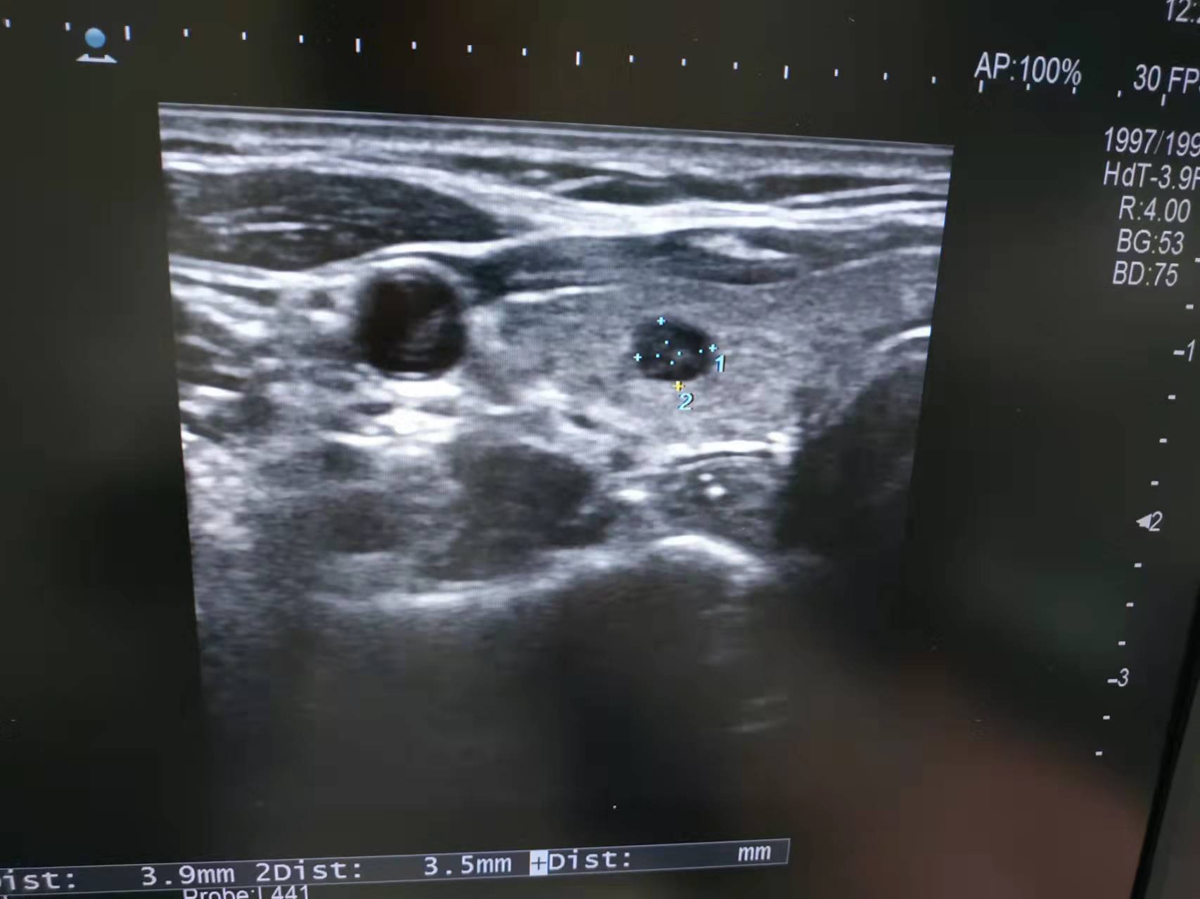 甲状腺超声图.jpg 甲状腺超声图.jpg