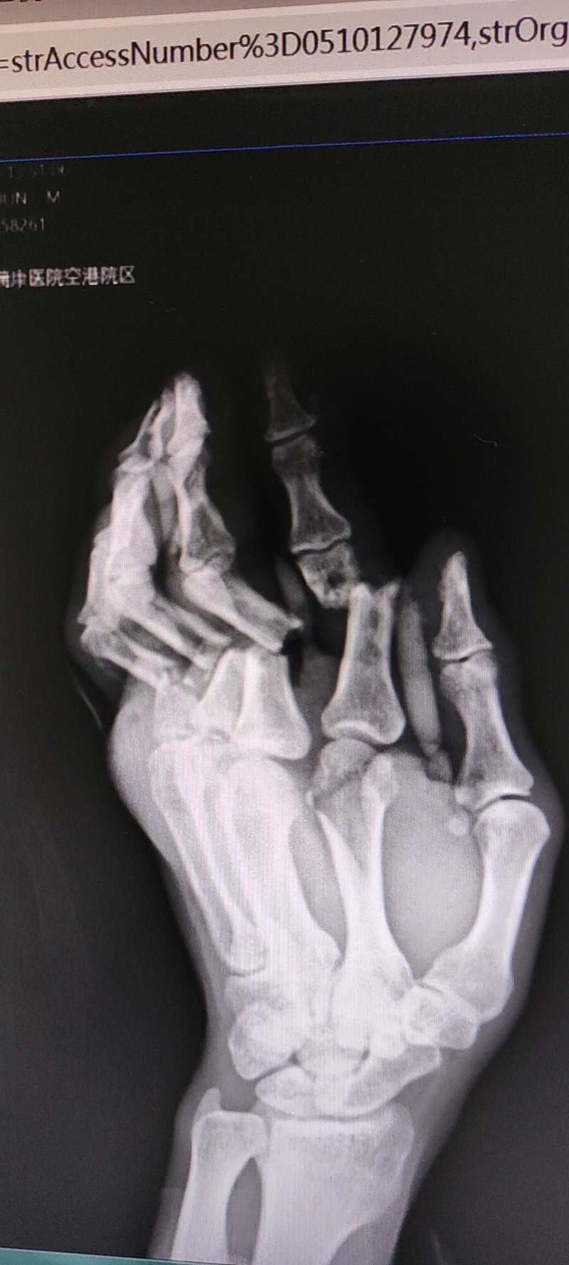 惊险！重物砸伤 4指断裂 看“绿色通道”如何妙手守护