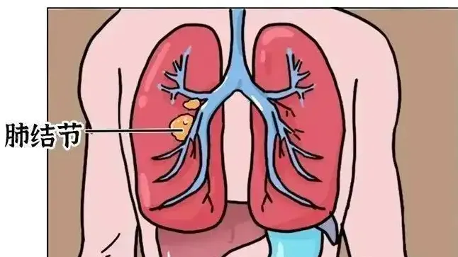 有肺结节，不要慌！瑞康医院中西医结合肺结节专病门诊开诊啦~