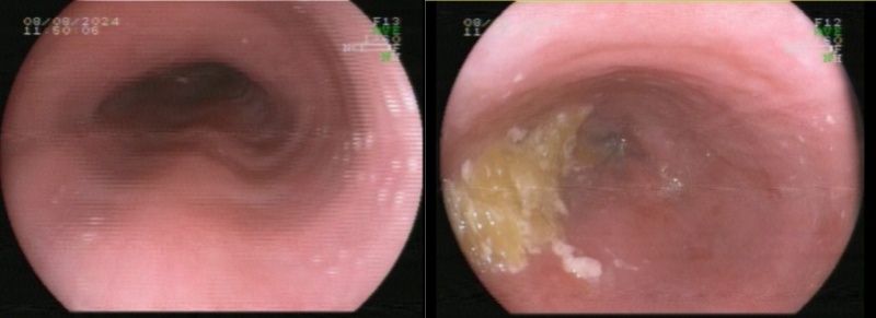 吃了就吐、烧心反胃……原来这不是消化不良，而是贲门失弛缓症惹的祸