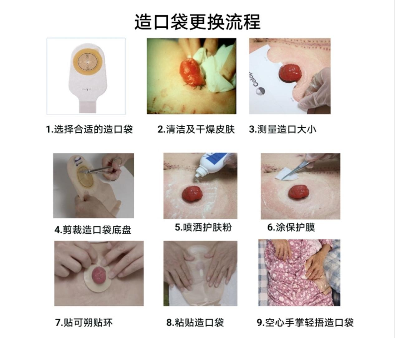 肠造口周围皮肤并发症的预防和护理---粪水性（刺激性）皮炎