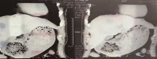 【南国早报】身体里缘何长“石头”？ 医生揭开其面纱胃结石女子空腹狂吃山楂 胃部出现鸡蛋大结石