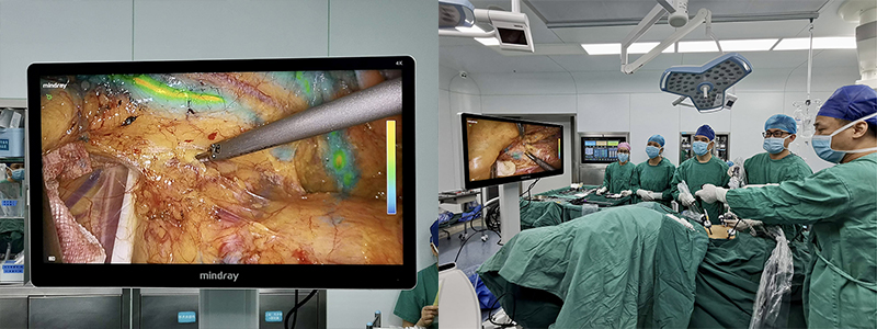 4 4k荧光腹腔镜手术.jpg 4 4k荧光腹腔镜手术.jpg