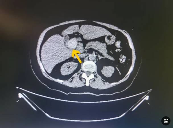 78岁奶奶的深情告白：这封感谢信，写给生命的“拆弹专家”