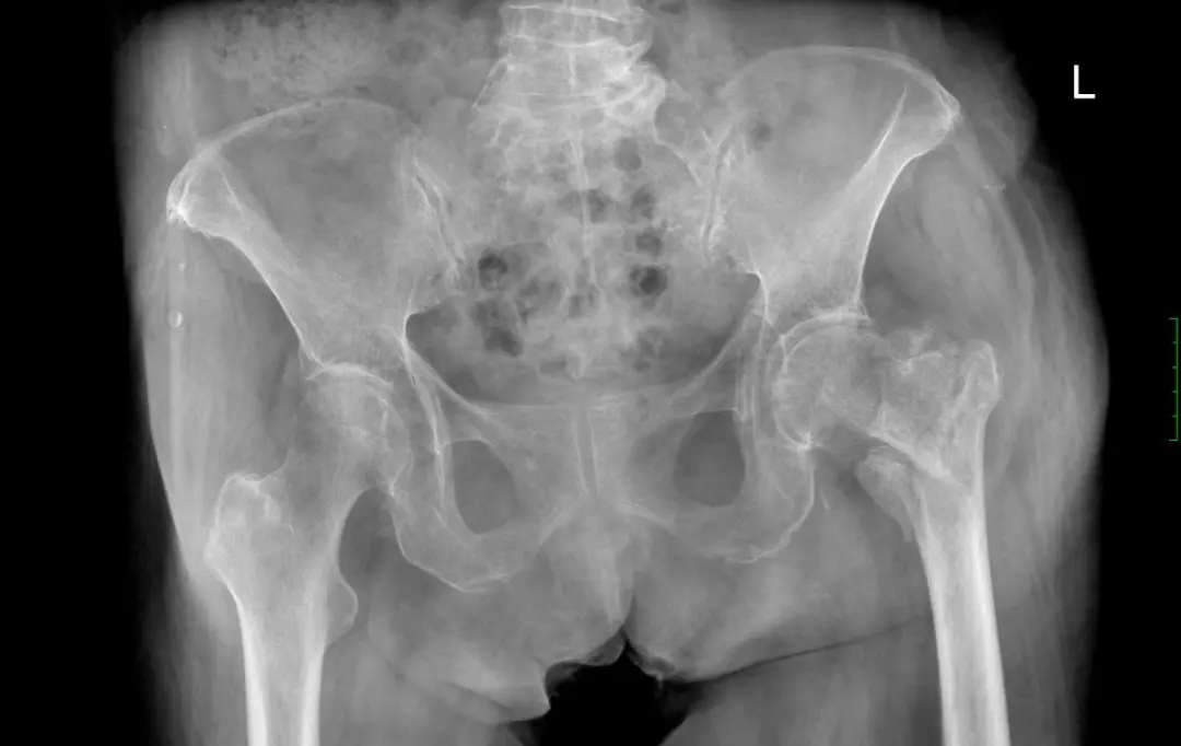 “八十而立”：86岁，她重新学会走路